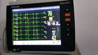 case of Ventricular Bigeminy changing to Trigeminy and Quadrigeminy [upl. by Aterg]