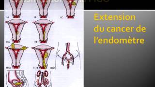 GYNECOLOGIE Cancer de l’endomètre 3 [upl. by Ecilayram]