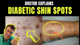 Doctor explains DIABETIC DERMOPATHY AKA DIABETIC SHIN SPOTS – plus causes and prevention [upl. by Lewert]