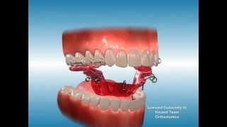 Palatal Expander [upl. by Hailat]