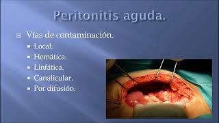 Peritonitis aguda [upl. by Adyam]