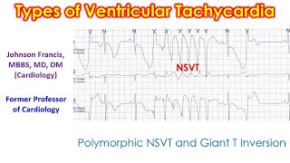 Types of Ventricular Tachycardia [upl. by Odnalor]