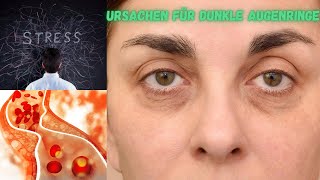 10 Ursachen für dunkle Augenringe und wie man sie bekämpft [upl. by Kelda]