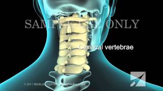 Lumbar Laminectomy [upl. by Yran]