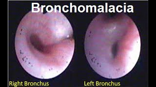 Bronchomalacia Treatment  Symptoms and Causes  Diagnosis  Prevention disease healthcare [upl. by Alhahs]