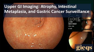 Upper GI Imaging Atrophy Intestinal Metaplasia and Gastric Cancer Surveillance [upl. by Einimod]