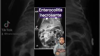 Enterocolitis necrosante ⚠️🧑‍⚕️ pediatrics intestino medico sabiasque medstudent med [upl. by Eran]