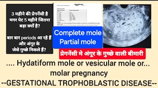 Molar pregnancy  Hydatiform mole kya होती है प्रेगनेंसी में अंगूर के गुच्छे वाली बीमारी GTD [upl. by Eromle619]