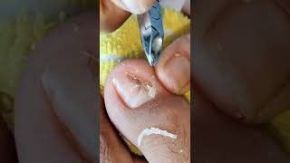 Toenail Cutting and Cleaning Discomfort Toenail Pedicure nailcare [upl. by Matilde]