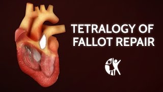 Tetralogy of Fallot Repair  Cincinnati Childrens [upl. by Gerrard]