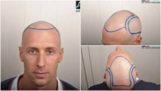 ASMED  Dr Koray Erdogan  3200 Grafts FUE hairtransplant hairtransplantturkey [upl. by Asilec]