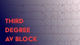 Third Degree Complete Heart Block  EKG ECG Interpretation [upl. by Wit]