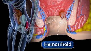 Hemorrhoid Removal  Step by step [upl. by Pippo959]