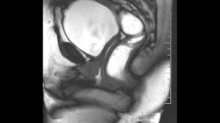 DEFECOGRAFIA RECTOCELE URETRA MG [upl. by Nodnek]