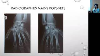 « Cas cliniques polyarthrite rhumatoïde » Dr SAbdellaoui [upl. by Atikel]