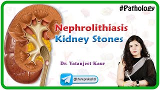 Nephrolithiasis  Kidney stones  Types Clinical features Diagnosis and Treatment Hindi [upl. by Letsou]