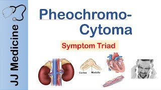 Pheochromocytoma  Symptoms and Treatment [upl. by Lleon]