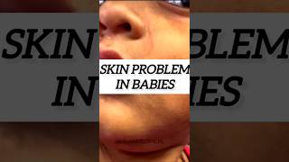 Skin Problem in Babies Expert advice Dr Imran Patel babyskincare sensitiveskin shortsfeed [upl. by Naejamron215]