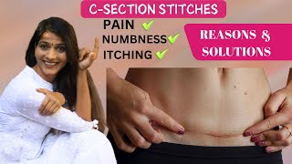 सिजेरियन डिलिव्हरी में stitches मै pain खुजली amp दर्द का solution Csection stitches painnumbness [upl. by Ajidahk]