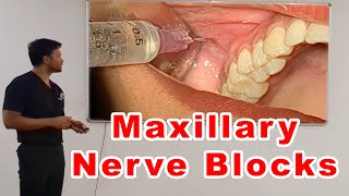 Maxillary Nerve Blocks Lecture  Dr Zibran Khan [upl. by Animaj]