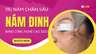 Trị nám chân sâu bằng laser công nghệ cao là như thế nào Xem ngay [upl. by Norrahs]