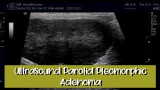 Ultrasound Parotid Gland Pleomorphic Adenoma [upl. by Llerrac]