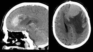 15NeuroradiologyCNSintersting casesCTMRIradiopediaradiologistmedicalimagefrcrtutorials [upl. by Gladis]