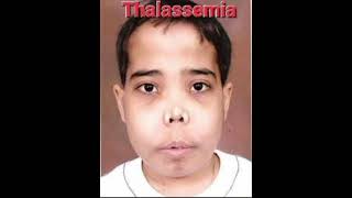 Thalassemia mrcpch Clinical Abdomen [upl. by Etnuahc644]