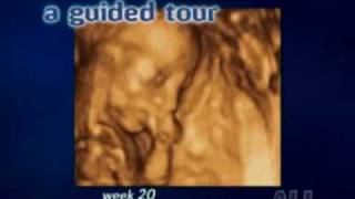 Echographie vidéo 3D du foetus [upl. by Almond]