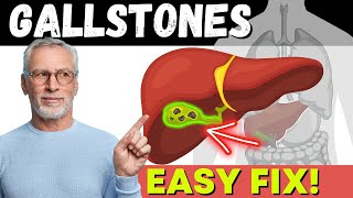 DISSOLVE GALLSTONES Permanently [upl. by Sollows542]