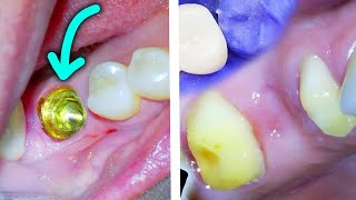 🦷 Dental Bridge vs Implant Dentist Explains Pros Cons amp How Each Is Done [upl. by Miguelita]