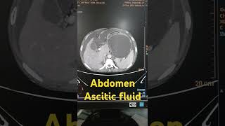 Abdomen ascitic fluid abdomen abdomenascitic shorts viralshorts [upl. by Nerrawed]