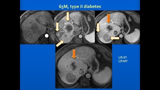 Hepatocellular Carcinoma Imaging LIRADS updated version at httpsyoutubeqmlhWFeDuo [upl. by Colston]