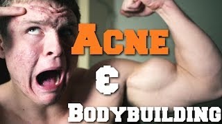 How To Get Rid of Acne as a Bodybuilder  Week 3 [upl. by Nosaes283]