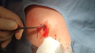 Dorsal Cyst Excision [upl. by Almena651]