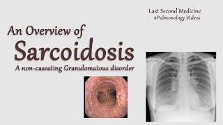 Sarcoidosis  A Quick and Easy Overview for revision [upl. by Javier]