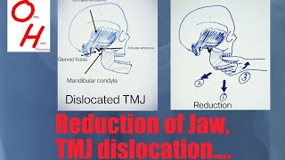 How to reduce a Temporomandibular TMJ Jaw dislocation [upl. by Michon]