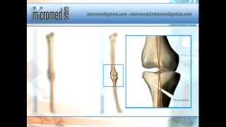 Osteomic  Sistema para osteoalineación tibial de Micromed System [upl. by Lachish]