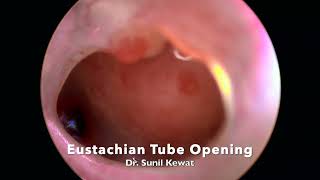 Eustachian tube opening view through central tympanic membrane perforation [upl. by Kanter724]