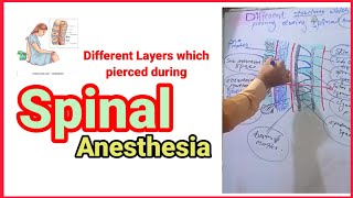 Layers which pierced during spinal anesthesia anaesthesiawithbabar2576 [upl. by Kreindler]