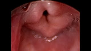 Laryngobronchoscopy  Laryngomalacia in a newborn baby [upl. by Nora891]