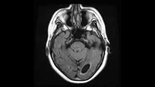 Periventricular leukomalacia Axial T2 FLAIR [upl. by Hulbard244]