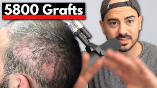 17 Monate nach 5800 Grafts  Haartransplantation Ergebnis eines Norwood 3 [upl. by Asiulairam383]