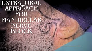 Extraoral Technique for Mandibular Nerve Block [upl. by Horowitz540]