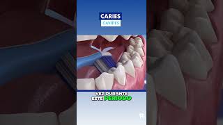 ¿Estás EMBARAZADA ¡Cuidado con la CARIES DENTAL [upl. by Eizzik]