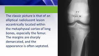 Non ossifying fibroma DrMSubbiah MD Pediatrics [upl. by Marika]