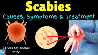 Scabies Causes Symptoms Diagnosis Treatment amp Prevention [upl. by Eduj541]