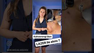 Lazerle Kahverengi Ben Alımı [upl. by Ytoc]