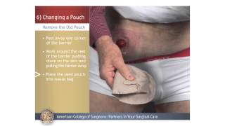 ColostomyIleostomy Changing a Pouch [upl. by Daryle263]