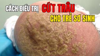 Cách Điều Trị Cứt Trâu cho Trẻ Sơ Sinh [upl. by Cicily]